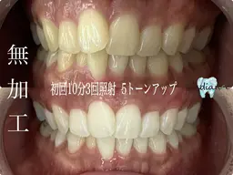 【初回のみ】1日完結☆セルフホワイトニング15分2回照射☆本数無制限