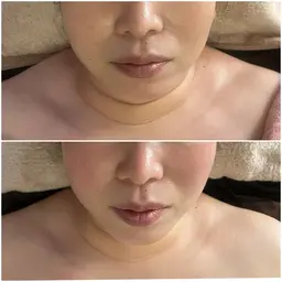 【くすみ・たるみ・むくみ・しわ・ほうれい線】美容鍼+デコルテカッピング+ヘッドマッサージ