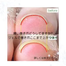 平日限定♪痛い巻き爪ケアーモニター募集♪
