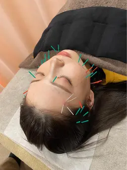 【初回】美容鍼✨💆🏻♀️【期間限定価格❗️】リフトアップ/むくみ/ほうれい線/しわたるみ/眼精疲労/顎関節症