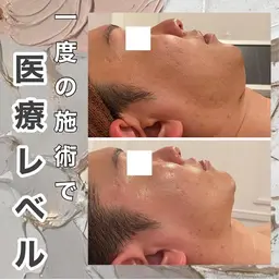 話題のリフトアップ施術💎チタニウムリフト⭐️たっぷり80KJ