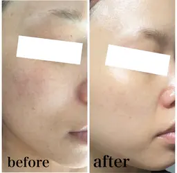 ヒト幹細胞配合ハーブピーリング🌿‬