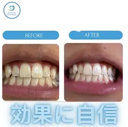 【1日完結型セルフホワイトニング歯の黄ばみ1日で解決】ワンデー美白ホワイトニング　結婚式前や歯をスグ白くしたい方オススメ