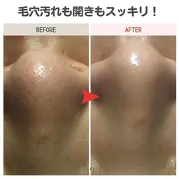 ✨人気No1メニュー✨毛穴洗浄ハイドロピーリング！長年の毛穴の黒ずみ＆角栓を解消♪60分4980円