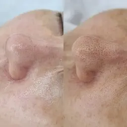 『毛穴徹底ケア💖』毛穴洗浄+アクアピール+小顔コルギ 90分¥12,900