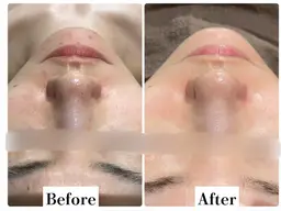 人気No.1肌質改善《リフトアップ美容液導入付》塗る糸リフトハイドロfacial🫧