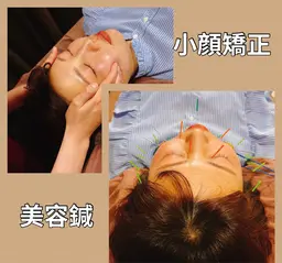 °ʚ🎀即効性バツグン🎀ɞ°.美容鍼➕小顔矯正➕首、肩マッサージ✨