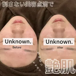 【 美容以上、医療未満 】毛穴/ニキビ/シミ にお悩みの方へ 肌質改善プログラム 🧬 無針水光注 × 毛穴洗浄set