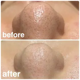 フェイシャルエステ