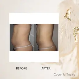 ぽっこりお腹解消コース