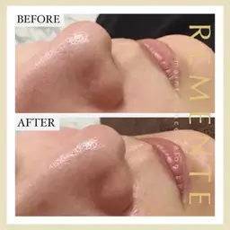 【✨口コミ記載の方体験半額！✨】★期間限定★毛穴の汚れを一掃✨ハイドラフェイシャル（毛穴洗浄）‼️ニキビや黒ずみに効果