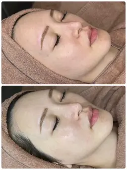 【美白・タイトニング】ミルクライト🐰🍼 症例写真の撮影可能な方📷