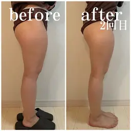 【脚やせコース✨】2つのマシーンでお悩みにしっかりアプローチ🌻むくみ、ハリ、セルライトが同時にケアできるコースです!