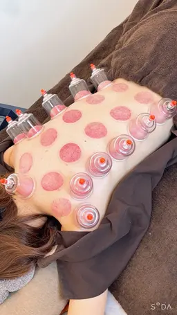 【大人気✨】吸玉(カッピング)🎉