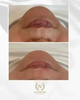 マツヤニパック