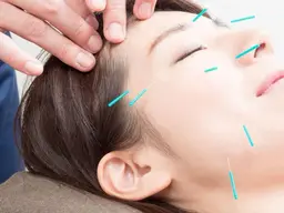 【初回12％off！美容鍼】頭痛、眼精疲労、食い縛りも改善（ヘッドマッサージ付）30分​〜​