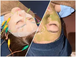 【🪡パック美容鍼×ハーブピーリング🌿】