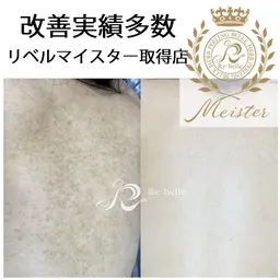 【剥離あり/ニキビケア毛孔性】リベルハーブピーリング背中上（2000円券付）90分