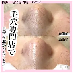 \毛穴スッキリコース/毛穴エクストラクションで黒ずみざらつきを一度でリセット！