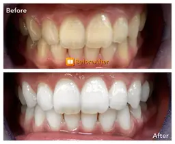 セルフホワイトニング 8分×2セット×５回券　　　22,000円→13,200円