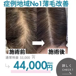 本気の薄毛改善 もう隠さない 頭皮集中改善ケア
