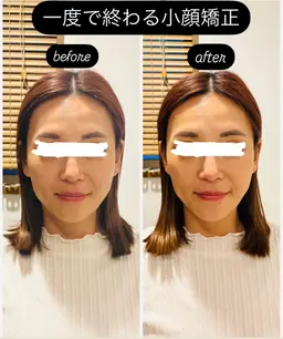 【生涯一度】の小顔矯正【全顔】￥56000⇒￥30000