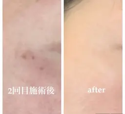 美白効果◎3月限定シミケア⚡️施術練習モデル