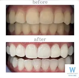 【お試し３回来店コース】ホワイトニング40分×3来店¥23,000→¥16,200