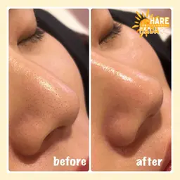 人気No.1🏆【しつこいニキビ・黒ずみ卒業✨】集中毛穴ケアコース👌🏻ハイドラ+ビタミンC導入🍋口コミ価格💭