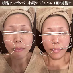 【DNA美容】内側からふっくら✨艶肌リフトアップフェイシャル 核酸セルボンバークリーム使用(60分)
