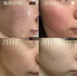 【今だけ‼️minimo限定キャンペーン価格✨🌿】剥離ありハーブピーリング💕🥚