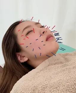 【今話題の美容鍼✨】美容鍼➕パルス電気鍼でむくみゼロのすっきり小顔に⭐️(カウンセリング込)