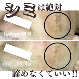 【最新の次世代シミケア】20ショット