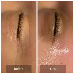 韓国モデル❤️小顔陶器肌コース【メラニンを含む古い角質毛穴汚れ除去💎】お茶カウンセリング込120分