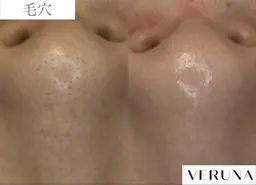 無料カウンセリング🆓 ニキビ/ニキビ跡/毛穴洗浄/シミ/シワ/くすみ/たるみ/小顔/乾燥/薄毛/白髪/ヘッドスパ