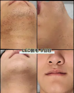 痛くない！キャンペーン50%OFF【U23限定】メンズフェイシャル脱毛　30分　¥4,400→￥2,200 回数１回