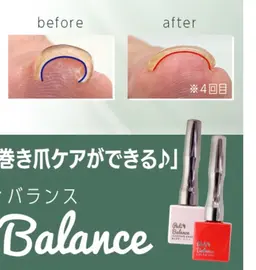 巻き爪ケア☆巻き爪でお困りの方必見です！！色はクリア色になります。1爪の料金になります。フット・ハンドの巻き爪OK🙆