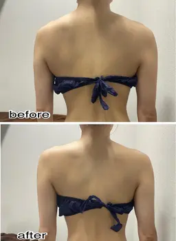 👤肩こりをスッキリ👤3D超音波リフト4000shot!!レディースメンズok👌❤️