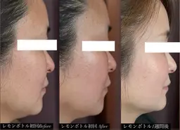30~40代に大人気【ほうれい線/たるみ/二重顎】韓国リフト+小顔矯正モニター¥10800