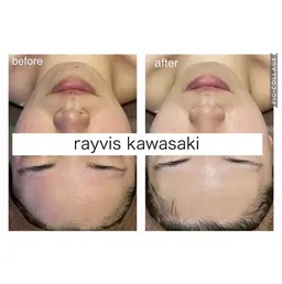 24歳以下限定🌸新生活応援!!白玉ピーリングで垢抜け透明感✨毛穴・美白フェイシャル体験￥1980