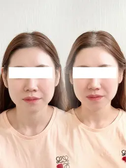 小顔フェイシャルエステ/ 小顔矯正