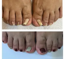 フットワンカラー＋巻き爪ケア（通常18700円→10000円）特殊なジェルを使って痛みなく巻き爪ケアをしていきます♪