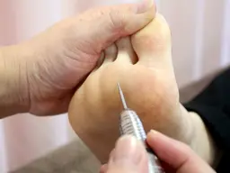 【ドイツ式フットケア】魚の目、タコ除去2か所まで 40分 ¥7,000→¥4.200