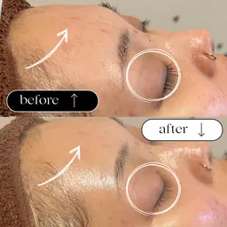 新規🎀期間限定🎀【高濃度スペシャルケア】あらゆる肌トラブルに対応!ヒト幹細胞と顔脱毛で肌質改善!手に入れようツヤ肌✨