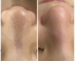 【minimo限定価格🉐】毛穴洗浄✨美肌パック付き❤️