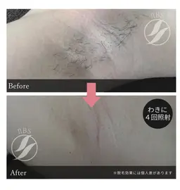 ワキ脱毛✖️3回