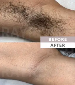 ［仙台　メンズ脱毛］　メンズワキ脱毛