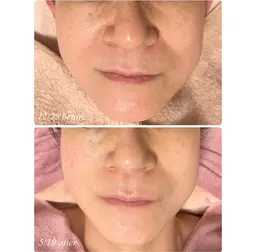 究極のリフトアップ3回コース❣️❣️FACE MAKE 4Dクリーム1本プレゼント🎁