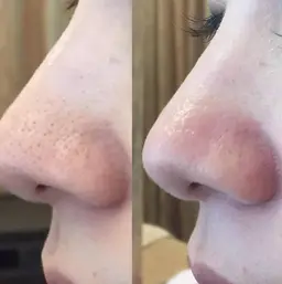 毛穴洗浄ピーリング★ハイドロスキン