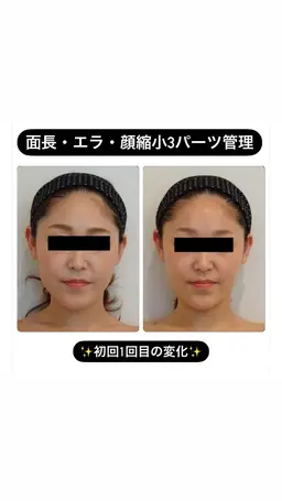 ✨極上小顔✨究極の3パーツ小顔矯正💆‍♀️一回で劇的な変化をお望みの方はこちらがオススメ💗80分